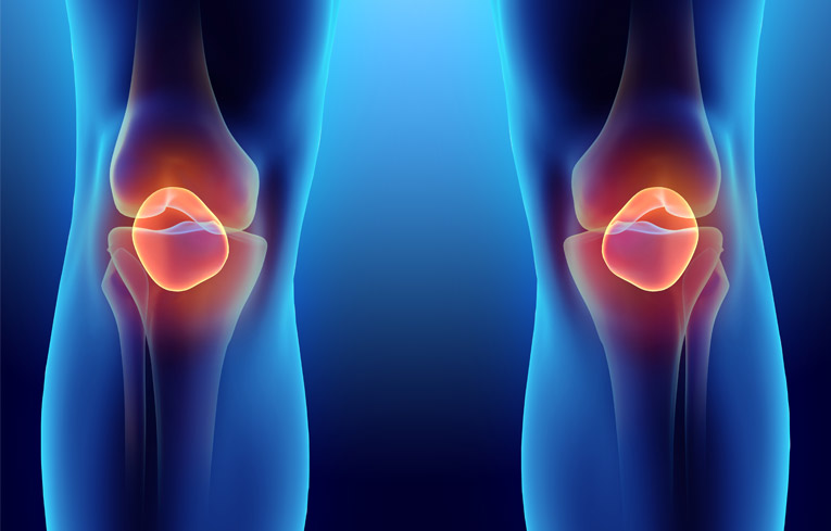 Post-Traumatic Arthritis