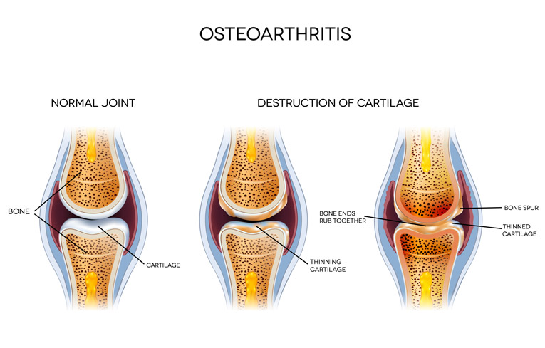 Degenerative Arthritis (Osteoarthritis)