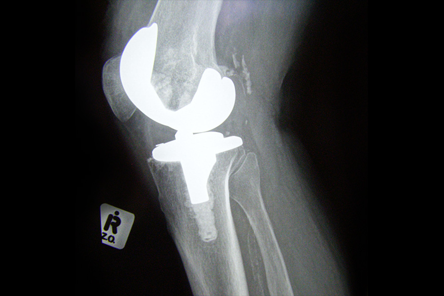 Knee Arthroplasty