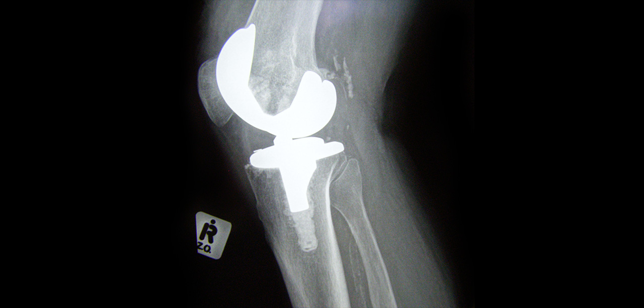 Total Knee Arthroplasty