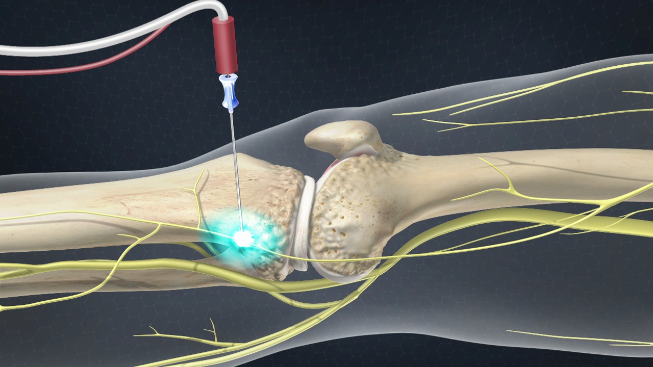 Comparison of Cooled Radiofrequency Ablation vs. Intra-articular
